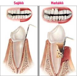 Dişeti Hastalıkları