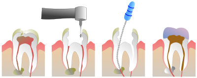 root Treatment